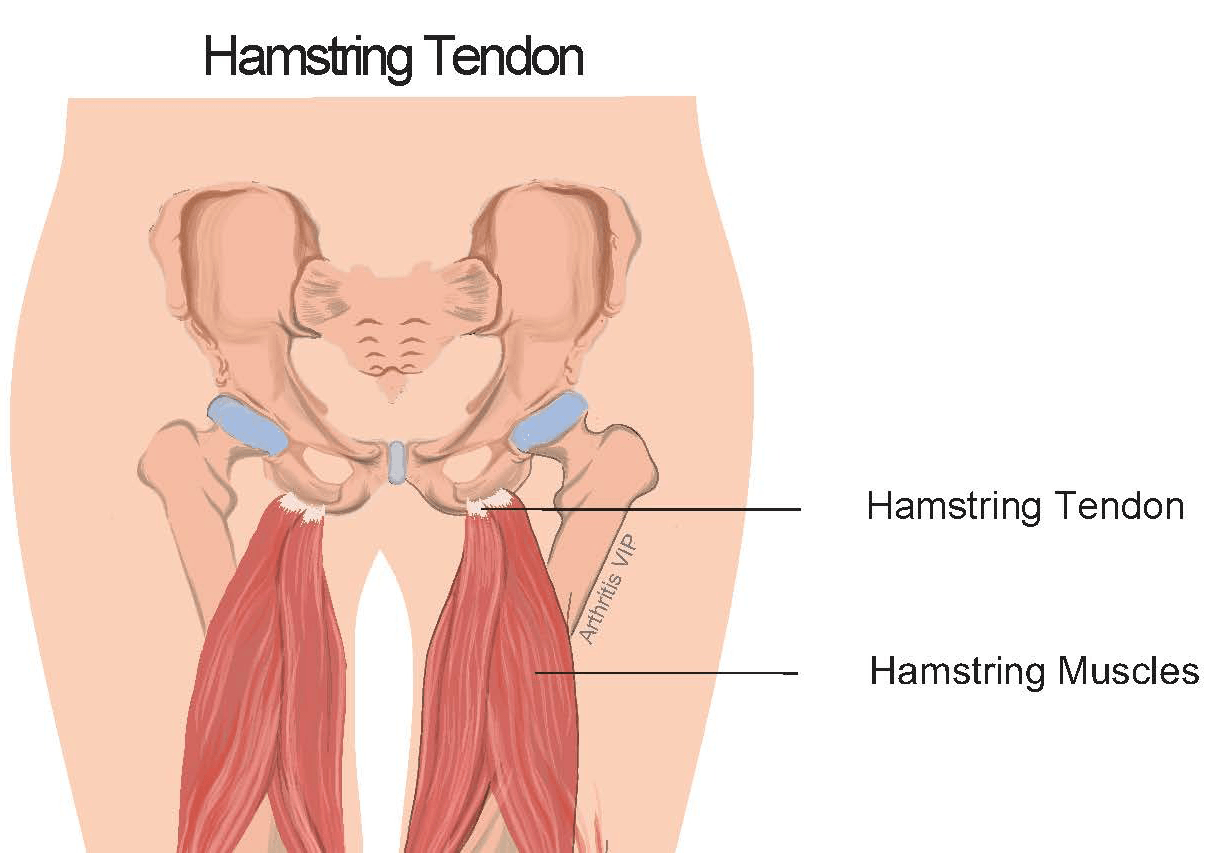Hamstring Tendon