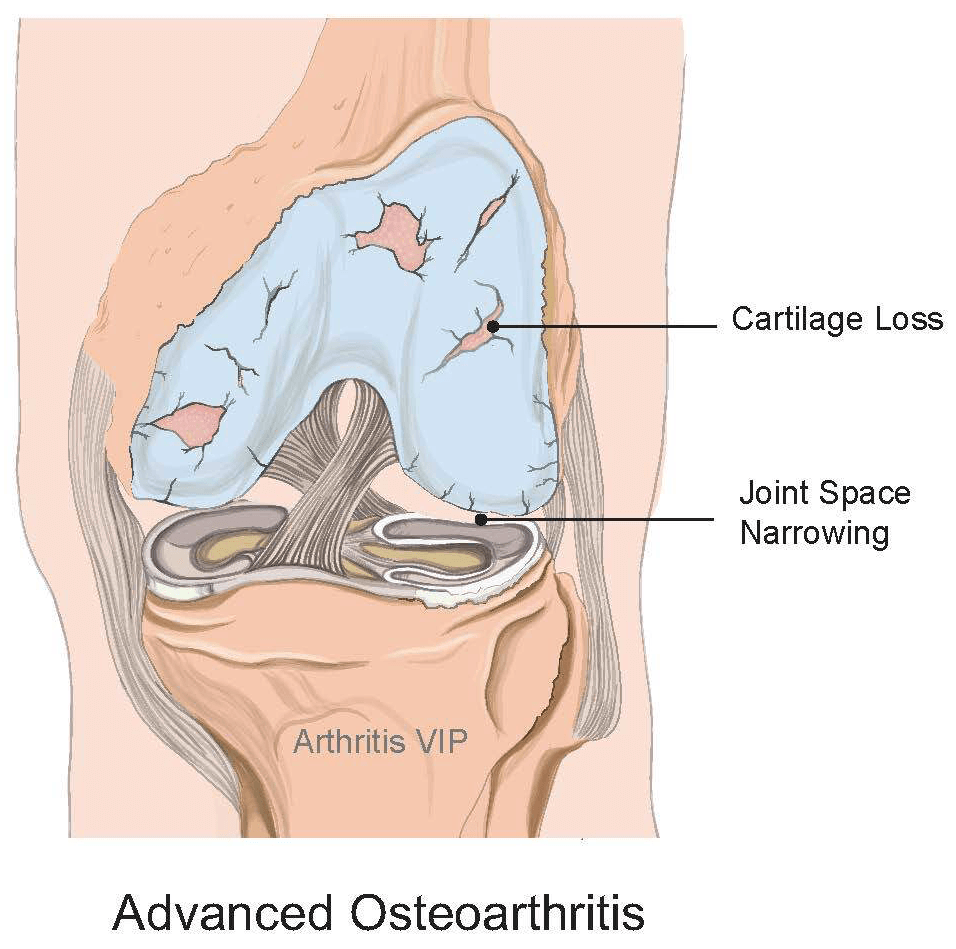 Advanced knee arthritis