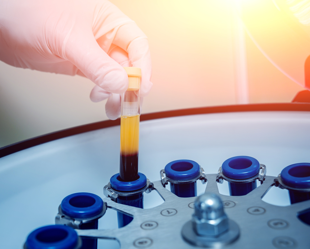 Benefits of Platelet Rich Plasma